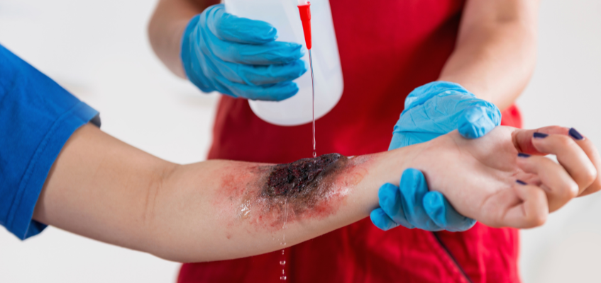 Primeros Auxilios en Quemaduras Eléctricas: Guía de Actuación y Cuidados en Panamá